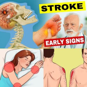 8 Warning Signs of Stroke You Shouldn’t Ignore