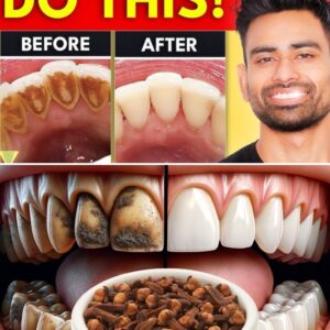 9 Natural Ways to Remove Plaque and Tartar